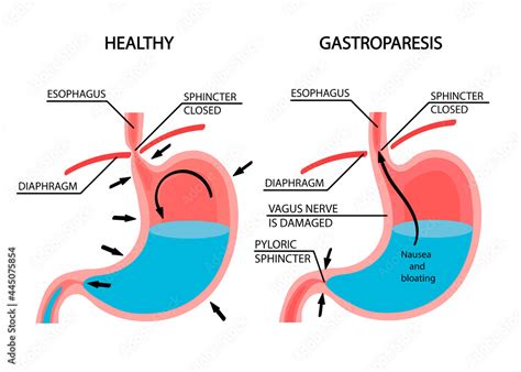 Visual comparison of healthy gastric and stomach with Gastroparesis ...