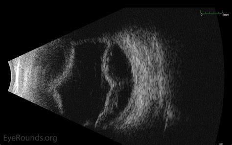 Atlas Entry - Uveal Effusion Syndrome