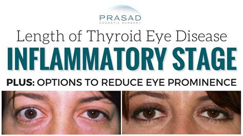 Early Symptoms Of Graves Eye Disease - recognize disease