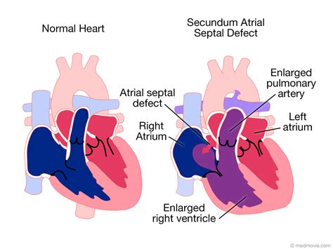 Atrioventricular Septal Defect