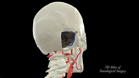 Basic Cranial Approaches - 3D Atlas of Neurological Surgery