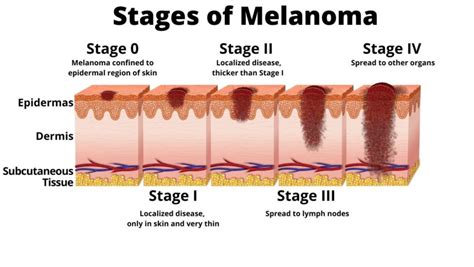 Melanoma In-Situ- Should You Worry? - PeopleBeatingCancer