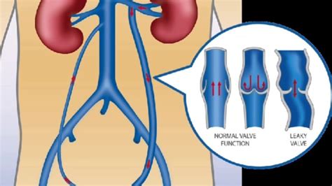 Everything You Need to Know About Varicocele Embolization - Seriable