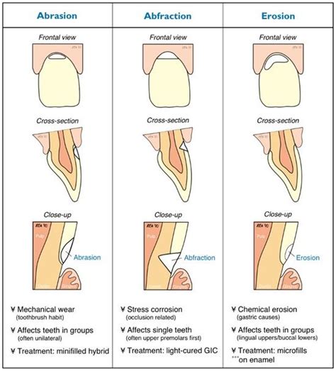 Abrasion - Abfraction - Erosion Dentaltown - ANGRY Patient after simple ...