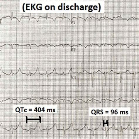 EKG on discharge showing normal QTc interval. | Download Scientific Diagram