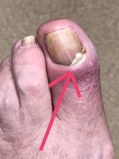 Infected toenail or nail fungus? – Dr. Nicholas Campitelli