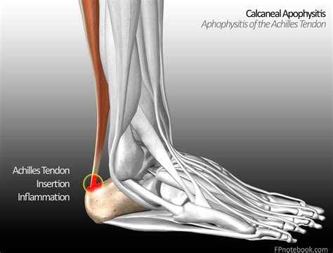 Calcaneal Apophysitis