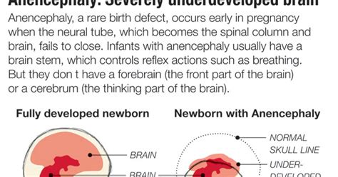 What Is Anencephaly and Is Organ Donation Possible?