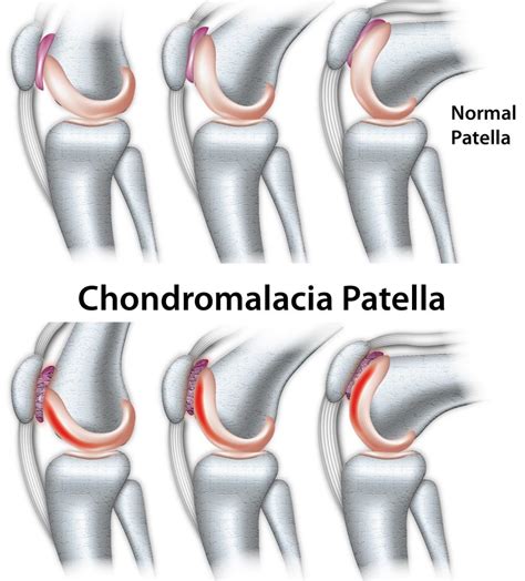 Chondromalacia Patella | Causes and Treatment | SportNova UK