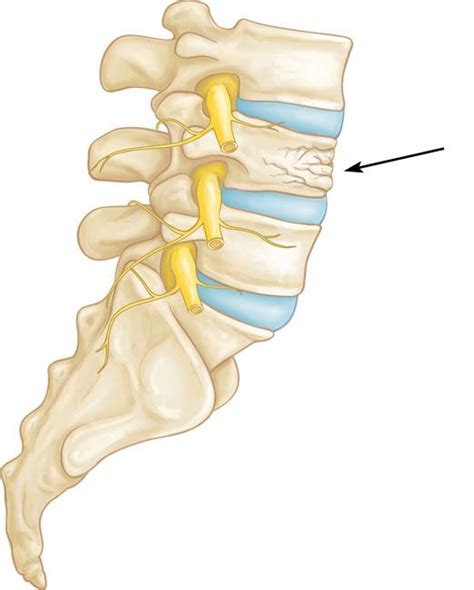 L1 Compression Fracture - Figgymcfatty