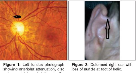 Figure 1 from Ocular ischemic syndrome and ischemic optic neuropathy in ...