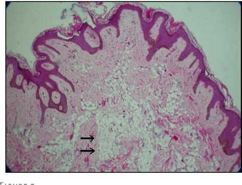 [PDF] Giant nevus lipomatosus cutaneous superficialis. | Semantic Scholar