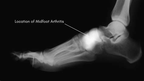 What causes pain on top of the foot? Explained by a Foot Specialist