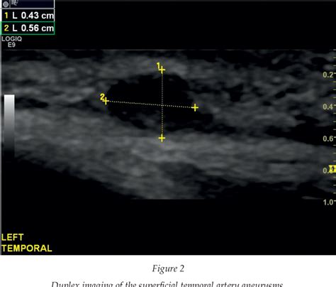 Figure 2 from Ultrasound Diagnosis of a Temporal Artery Aneurysm ...