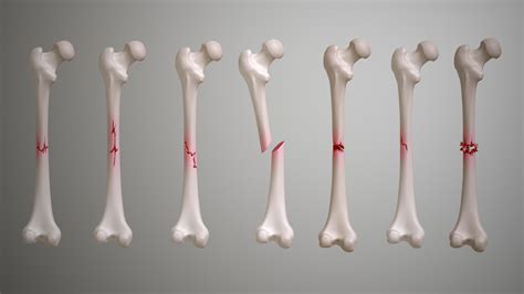 Fractures: Types, Symptoms, Causes and Treatment - Scientific Animations