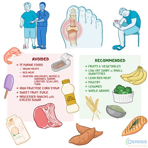 Anti-gout Diet: Foods to Eat, Foods to Avoid | Osmosis