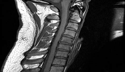 Regeneration of Nerve Connections after Spinal Cord Injury - PTEN ...