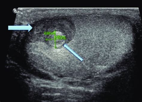 Epidermoid Cyst Ultrasound