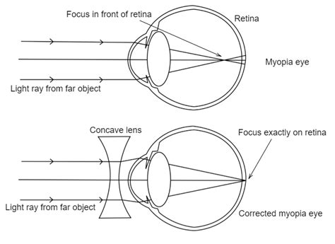 Draw ray diagrams each showing (i) myopic eye and (ii) hypermetropic eye.