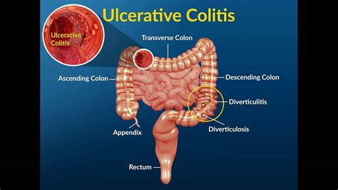 Mucus in Stool The Best Treatment Options english - YouTube