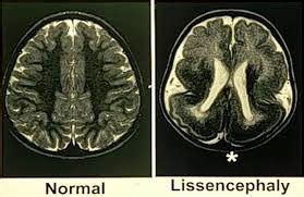 Lissencephaly Syndrome