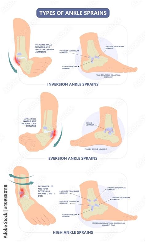 injury Talo Fibular foot treat high low roll twist tear tough bands ...