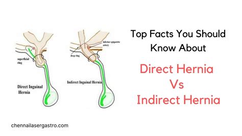 Direct Inguinal Hernia Anatomy