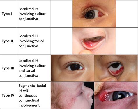 Casa Aplicado Perjudicial hemangioma en el ojo del bebe Inmundicia ...