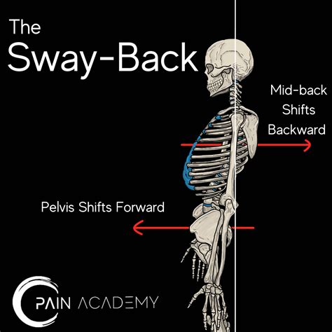 Sway-Back Posture – Pain Academy