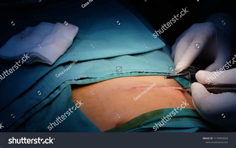 Subcuticular Skin Suturing During Closure Wound Stock Photo 1110993569 ...