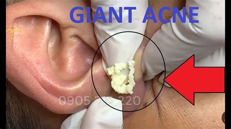 REMOVAL THE SAC on the ear cyst 19 | Loan Nguyen - YouTube