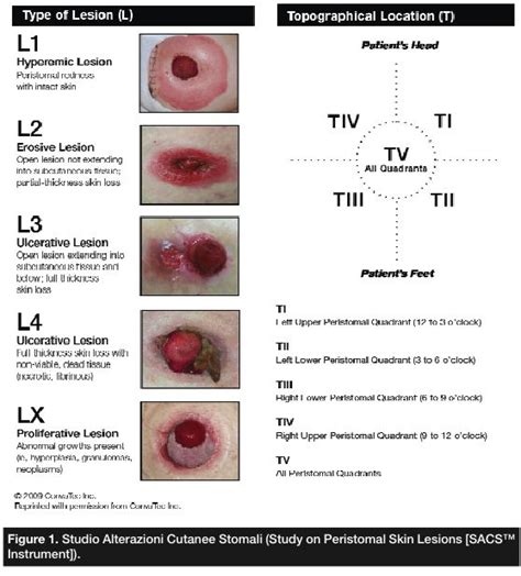 57 best images about Ostomy Care on Pinterest | How to sleep ...