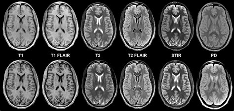 Mri Scan Result