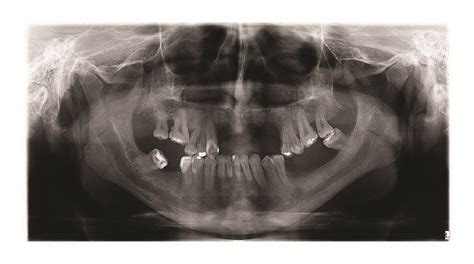 Panoramic Radiograph of the case. Enlargement of mandibular canal in ...