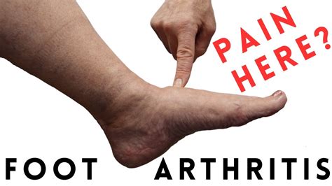 Foot Arthritis Pain: Most Common Signs and Symptoms - YouTube