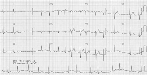 Atrial Fibrillation • LITFL • ECG Library Diagnosis