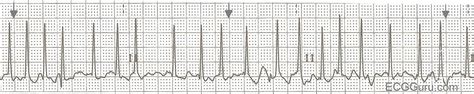 Atrial Fibrillation With Slow Ventricular Response