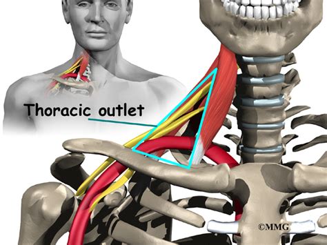 Thoracic Outlet Syndrome | eOrthopod.com