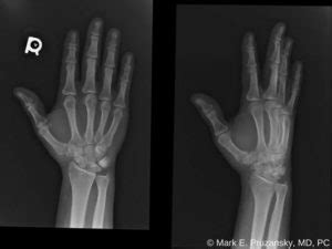 Bennett Fracture-Dislocation | New York, NY | HandSport Surgery Institute