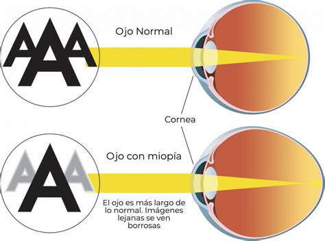 ¿Qué es la miopía?