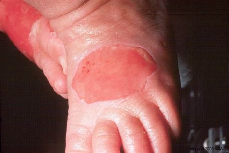 Wound Care Images | WoundEducators.com