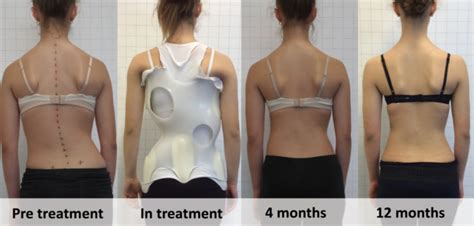 Scoliosis Bracing Huntington Chiropractors | Waterfront Chiropractic ...