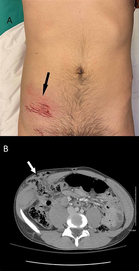 Management of Traumatic Spigelian Hernia: A Case Report and Literature ...