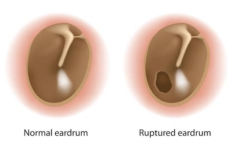 Perforated Eardrum Symptoms, Causes and Treatments | MD-Health.com