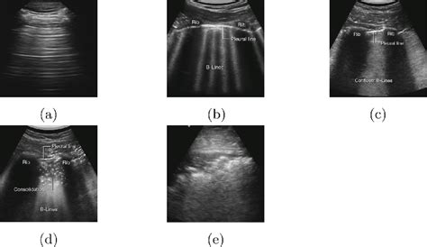 Lung Ultrasound Images: (a). A-Lines, (b). B-Lines, (c). Confluent ...