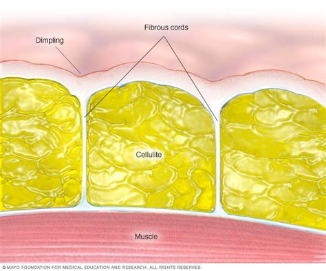 Cellulite - Symptoms and causes - Mayo Clinic