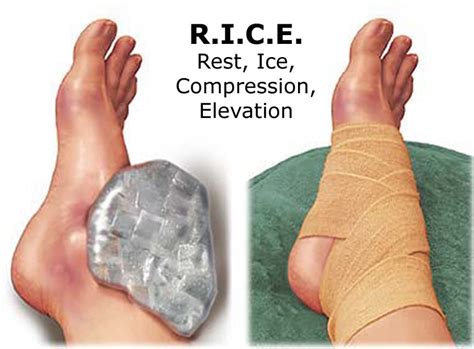 How Long should you Rest and Ice a Sprained Ankle?