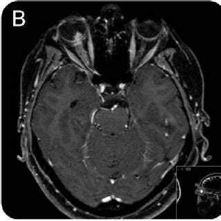 MRI in optic perineuritis | Download Scientific Diagram