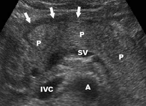 Acute Pancreatitis - Stepwards