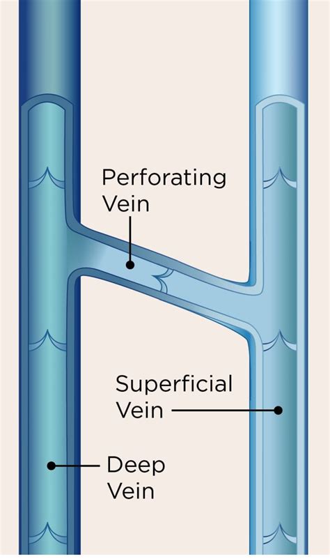 Ultrasound Guided Sclerotherapy - Alaska Vein Clinic